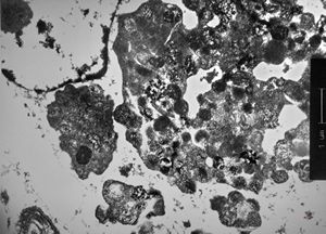 F,54y. | giant complex melanosomes … melanotic carcinosarcoma - uterus